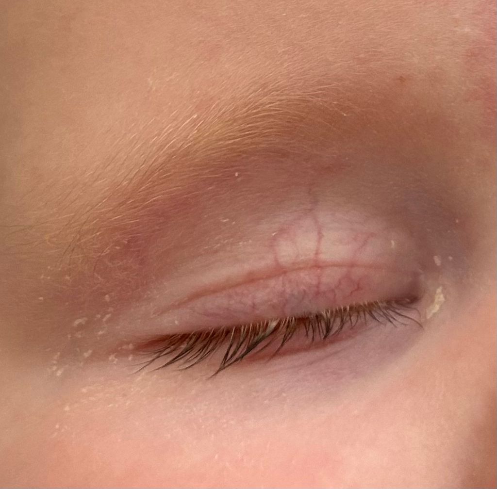 Eye Gunk Baby's First Year Forums What to Expect