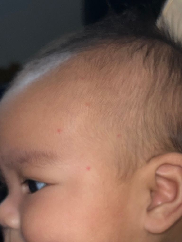 Baby woke up with red dots on face!!! Baby's First Year Forums