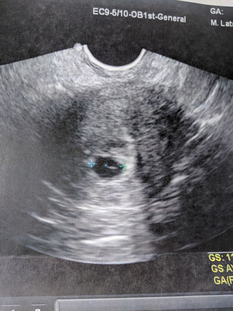 Bleeding And Cramping 5 Weeks 5 Days, Ivf Pregnancy - 1St Pregnancy | Forums | What To Expect