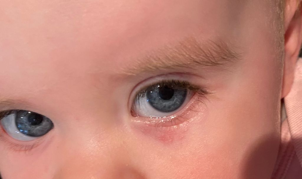 Rash Under Baby's Eye - March 2020 Babies | Forums | What To Expect