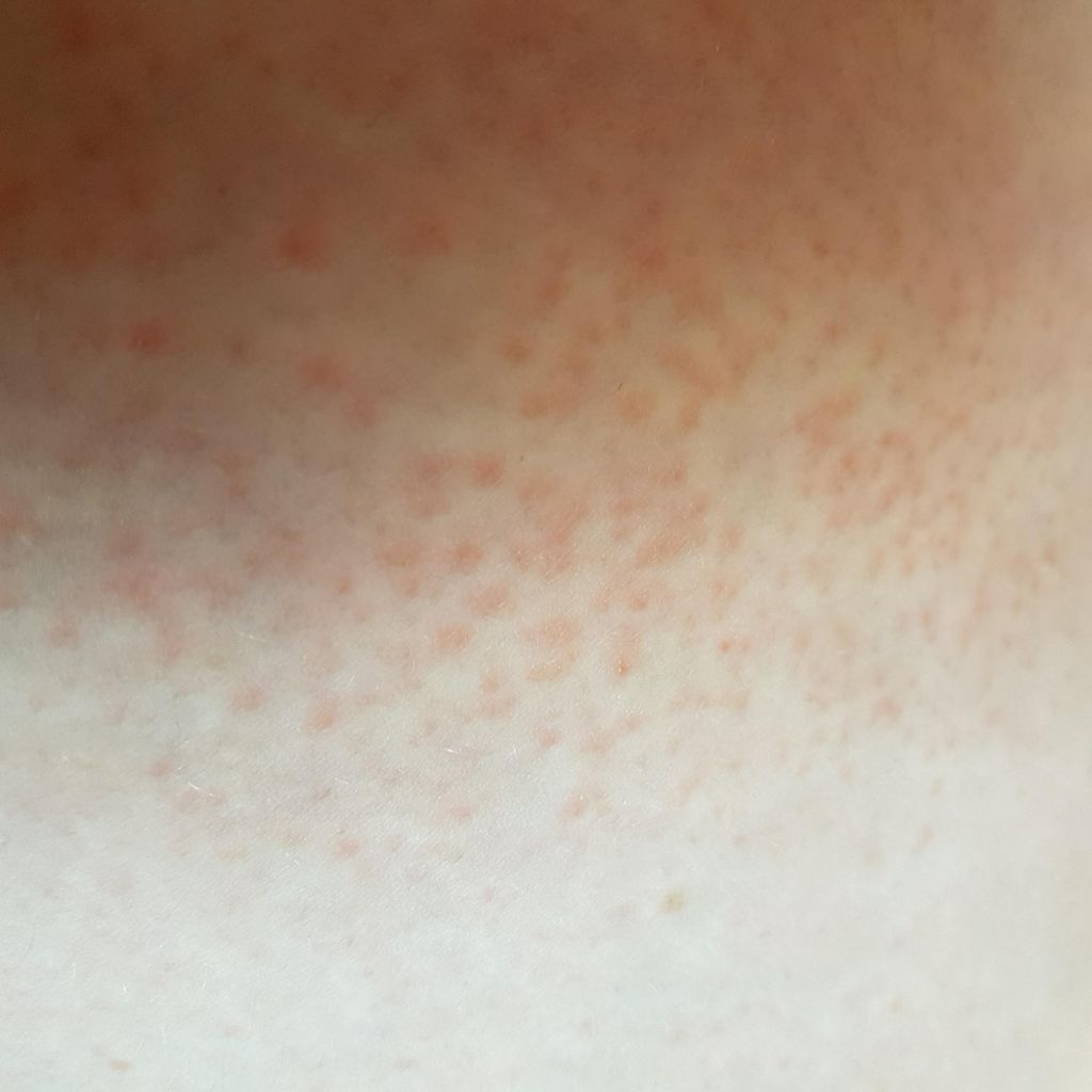 Rash On Thigh