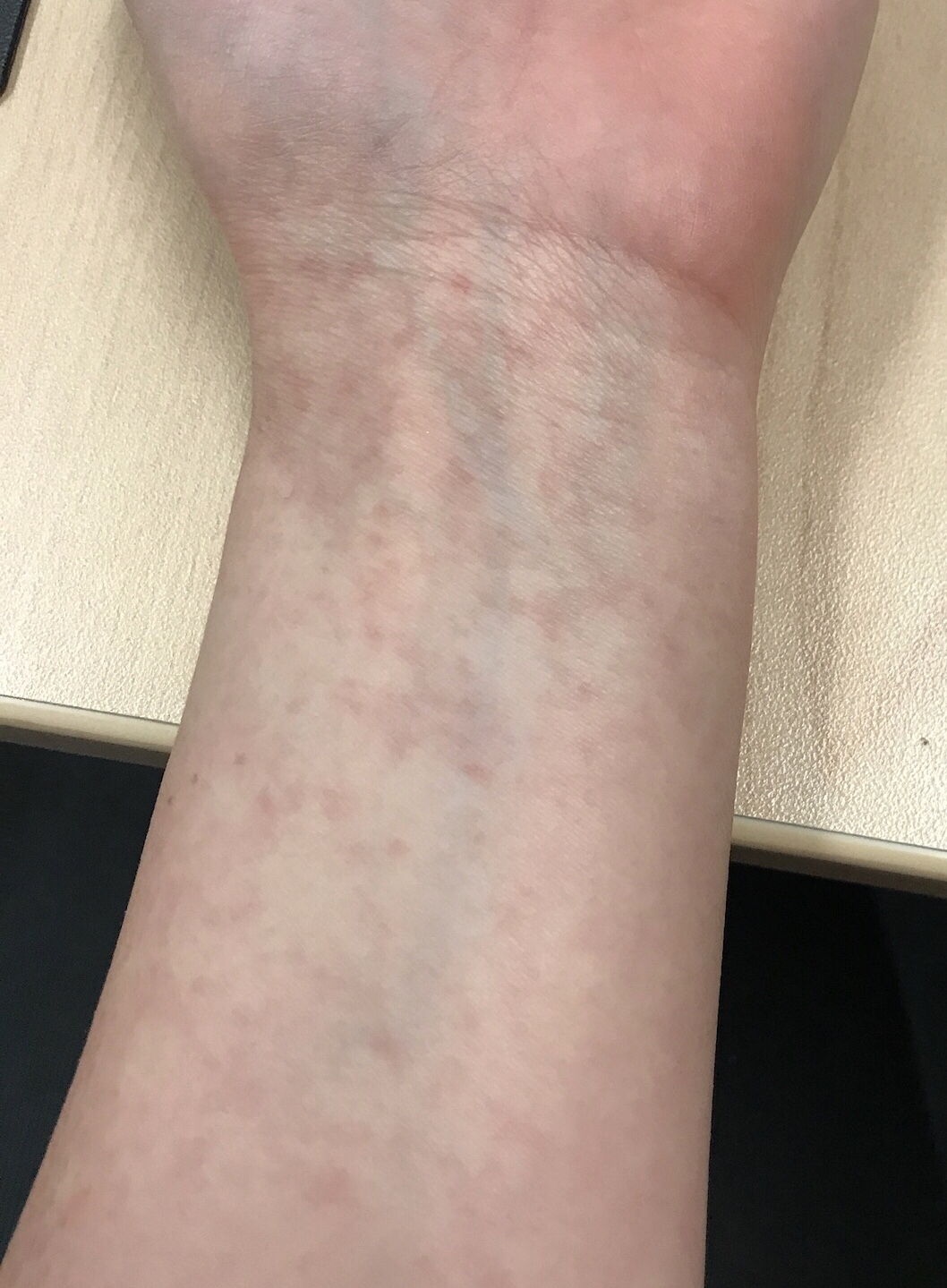 Bumpy Rash On Forearms
