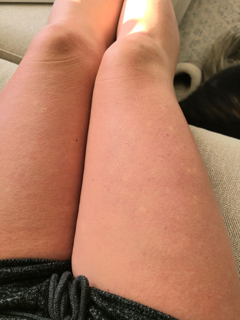 White Spots Legs?! - October 2021 Babies | Forums | What To Expect