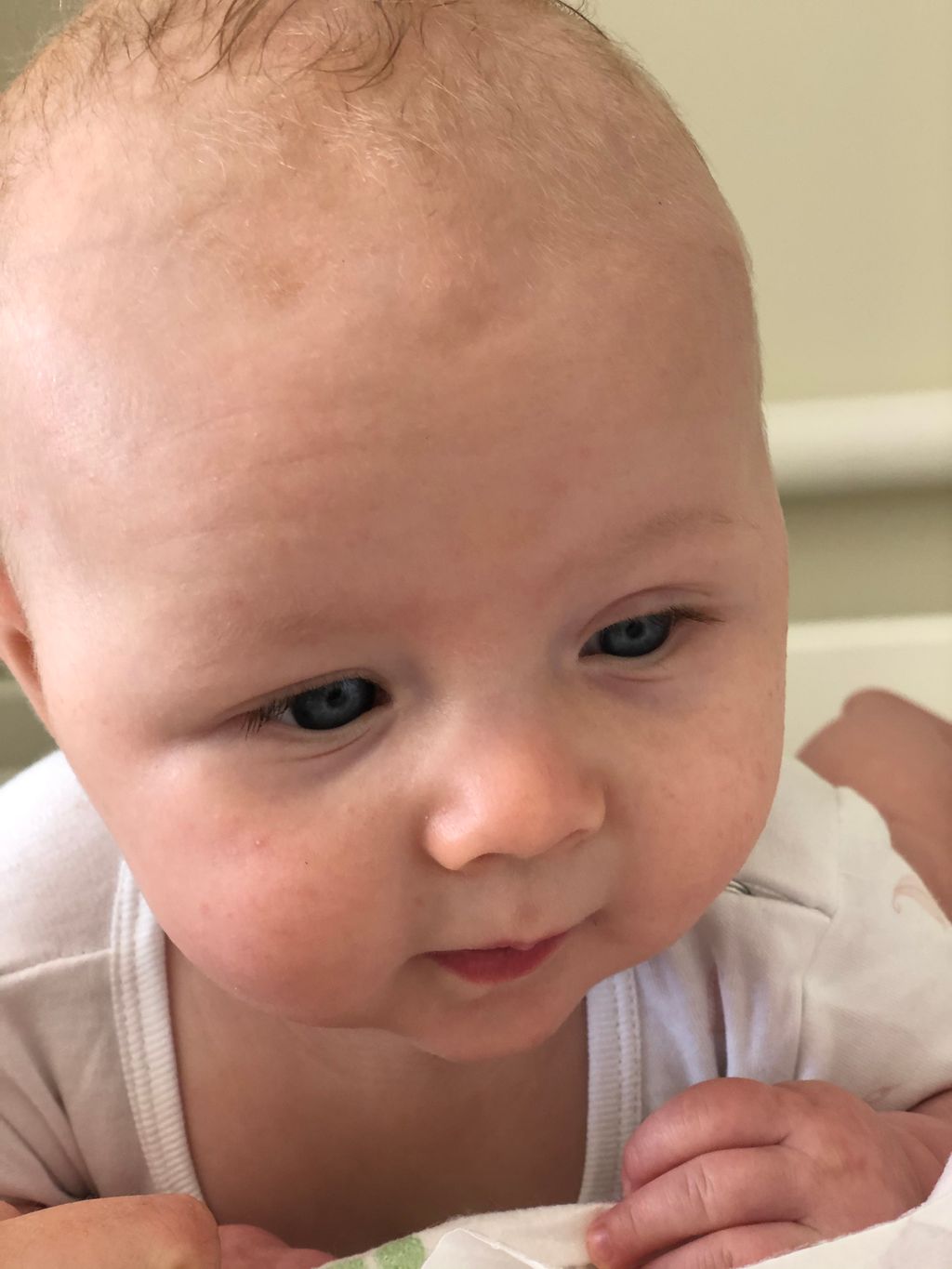 Baby has “bags” under eyes (pics included) August 2019 Babies Forums What to Expect