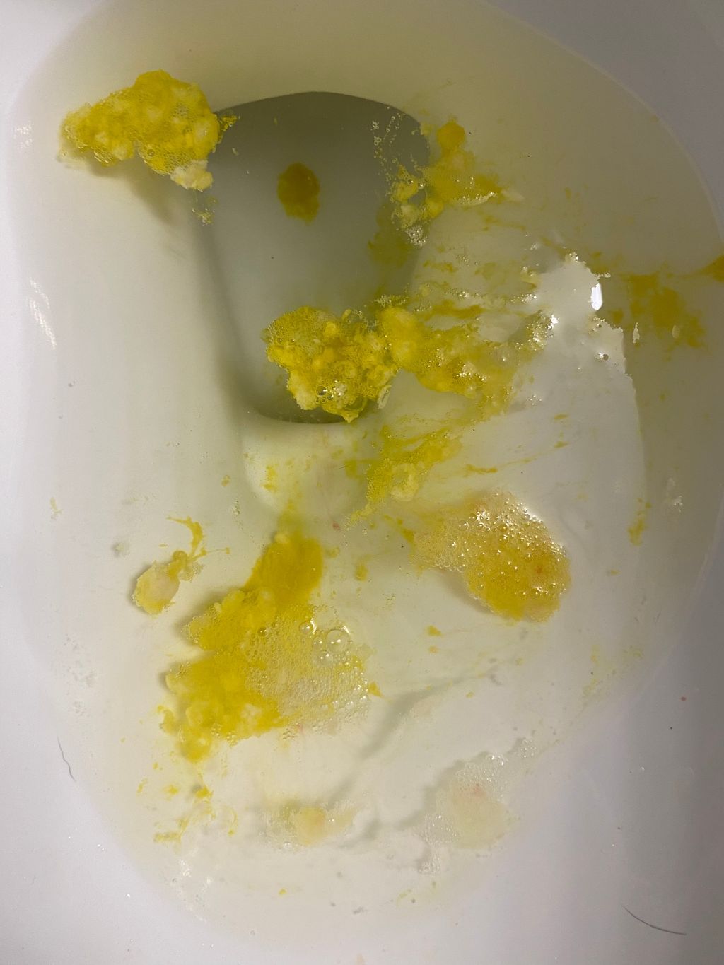 Throwing Up Yellow “Foam”? Tmi Pic - 1St Pregnancy | Forums | What To Expect
