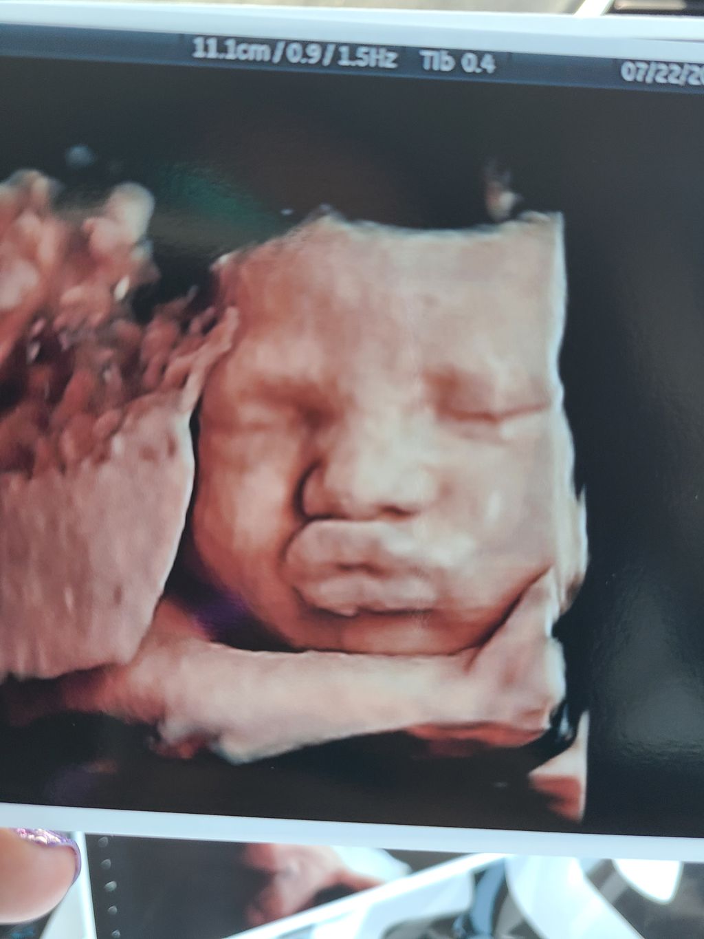 Black Baby 3d Ultrasound