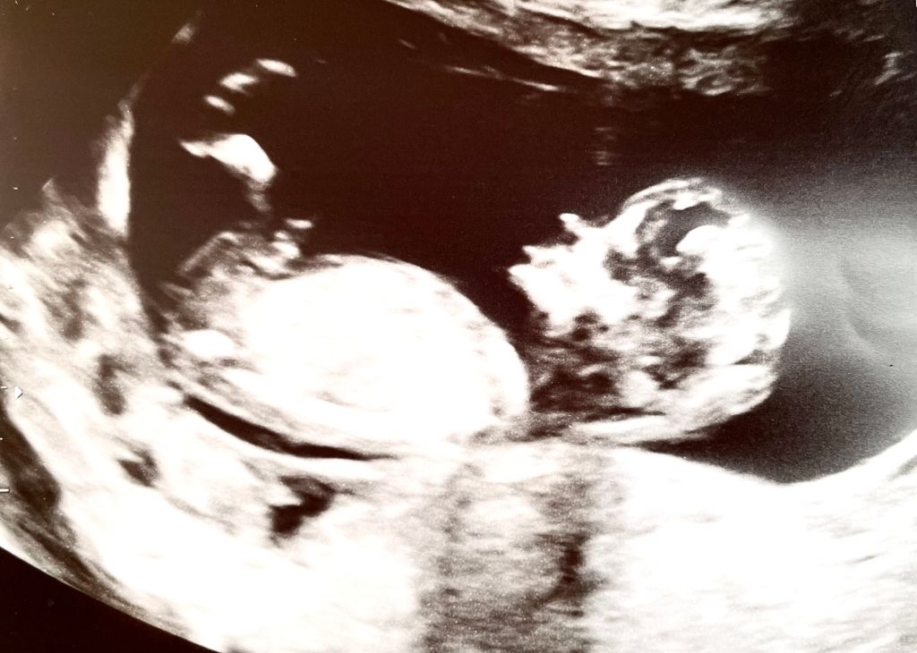 Any guesses?? Gender prediction Forums What to Expect