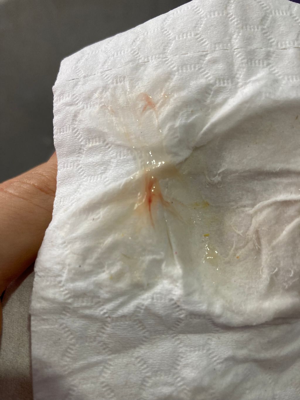 TW Pics included Implantation Bleeding? Trying to Conceive Forums