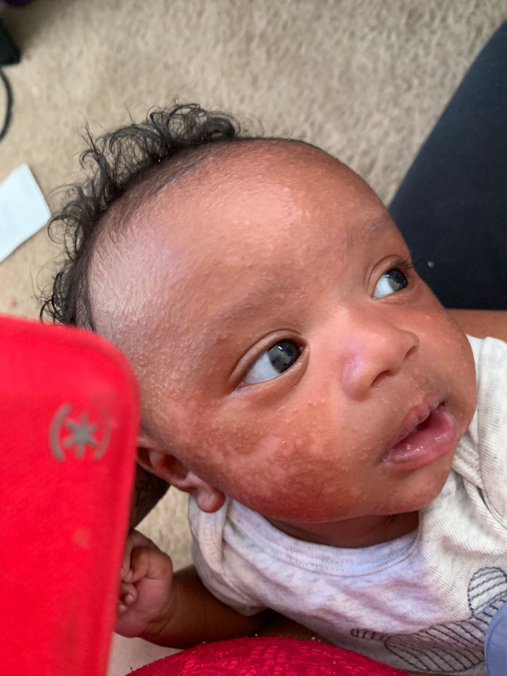 Light Patches On Face Child