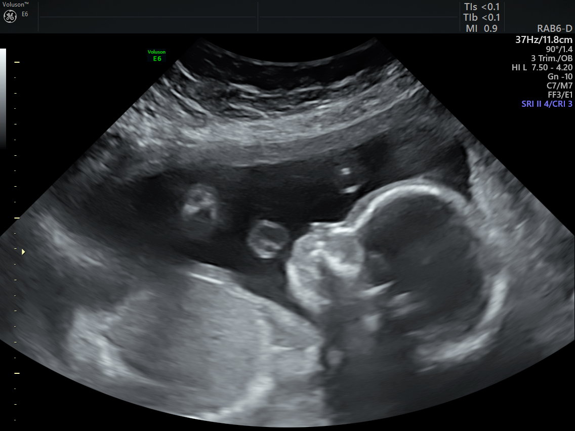 8 Week Ultrasound Hidden Twins