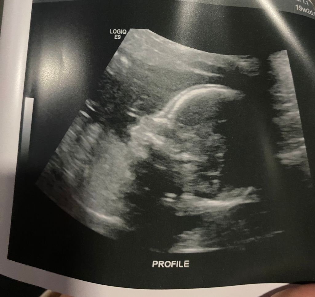 Two glucose screenings yay March 2025 Babies Forums What to Expect