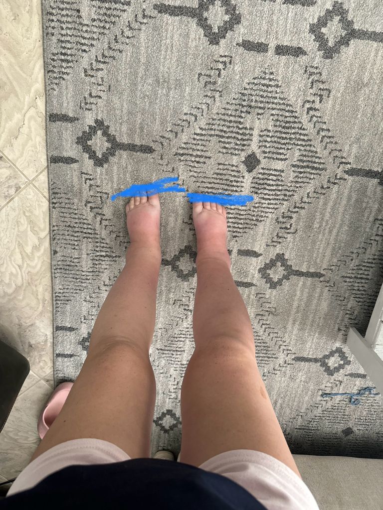 Having all preeclampsia symptoms except hbp Preeclampsia and HELLP