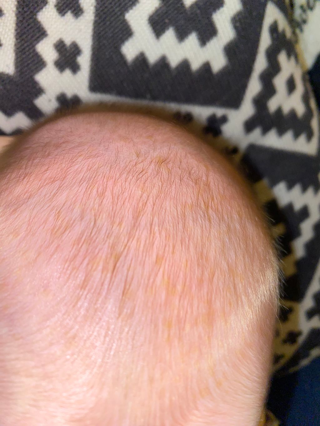 Cradle cap? July 2024 Babies Forums What to Expect