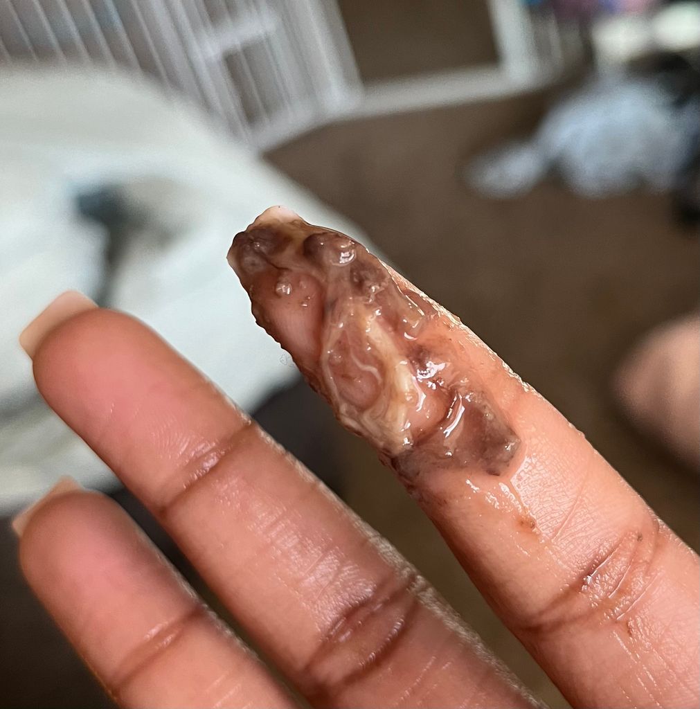 TW — blood photos. Miscarriage at 5 weeks is there hope ? June 2025