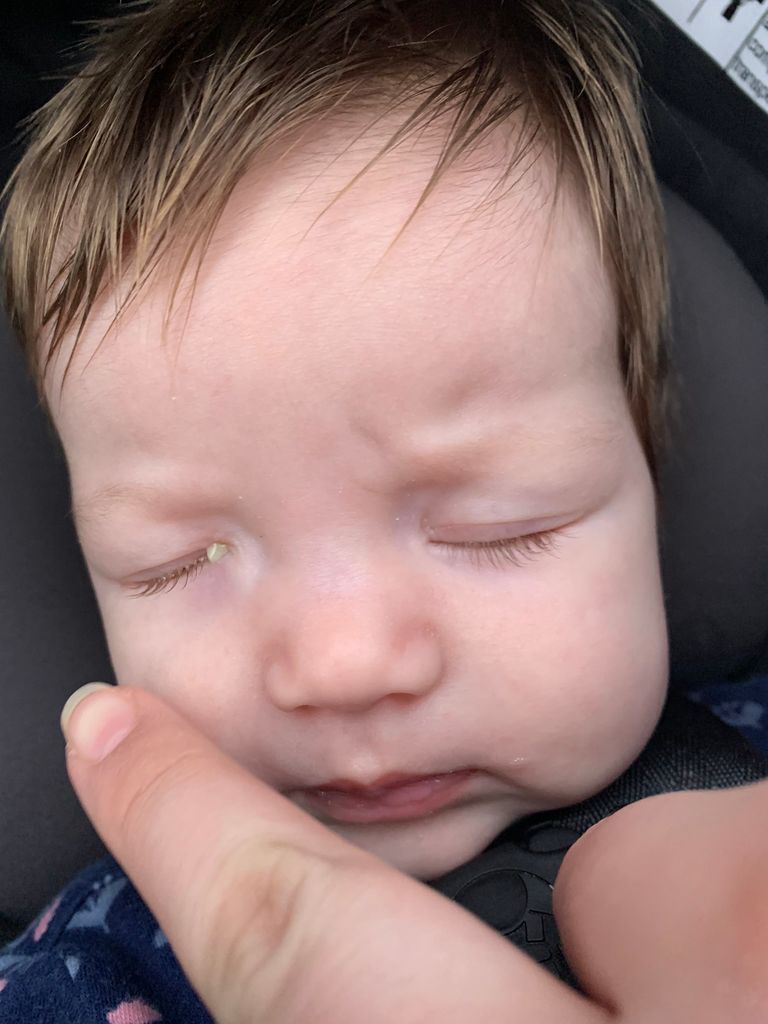Blocked tear ducts, yellow gunk in eye February 2024 Babies Forums