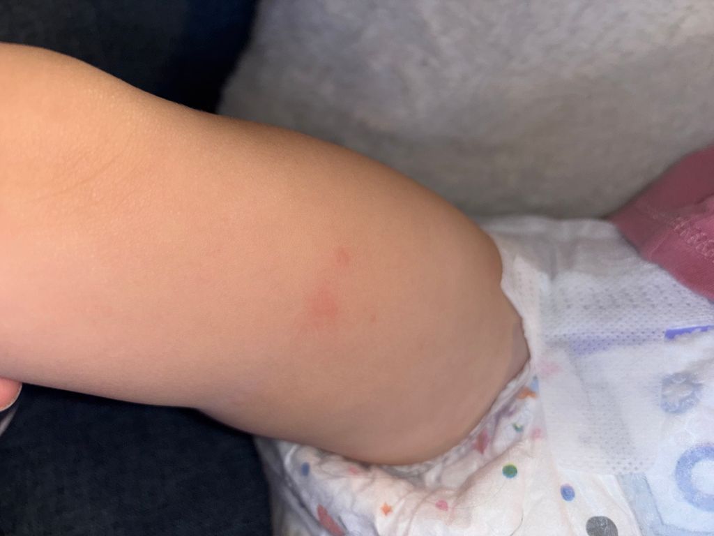 HELP? Rash? What is this!? May 2023 Babies Forums What to Expect