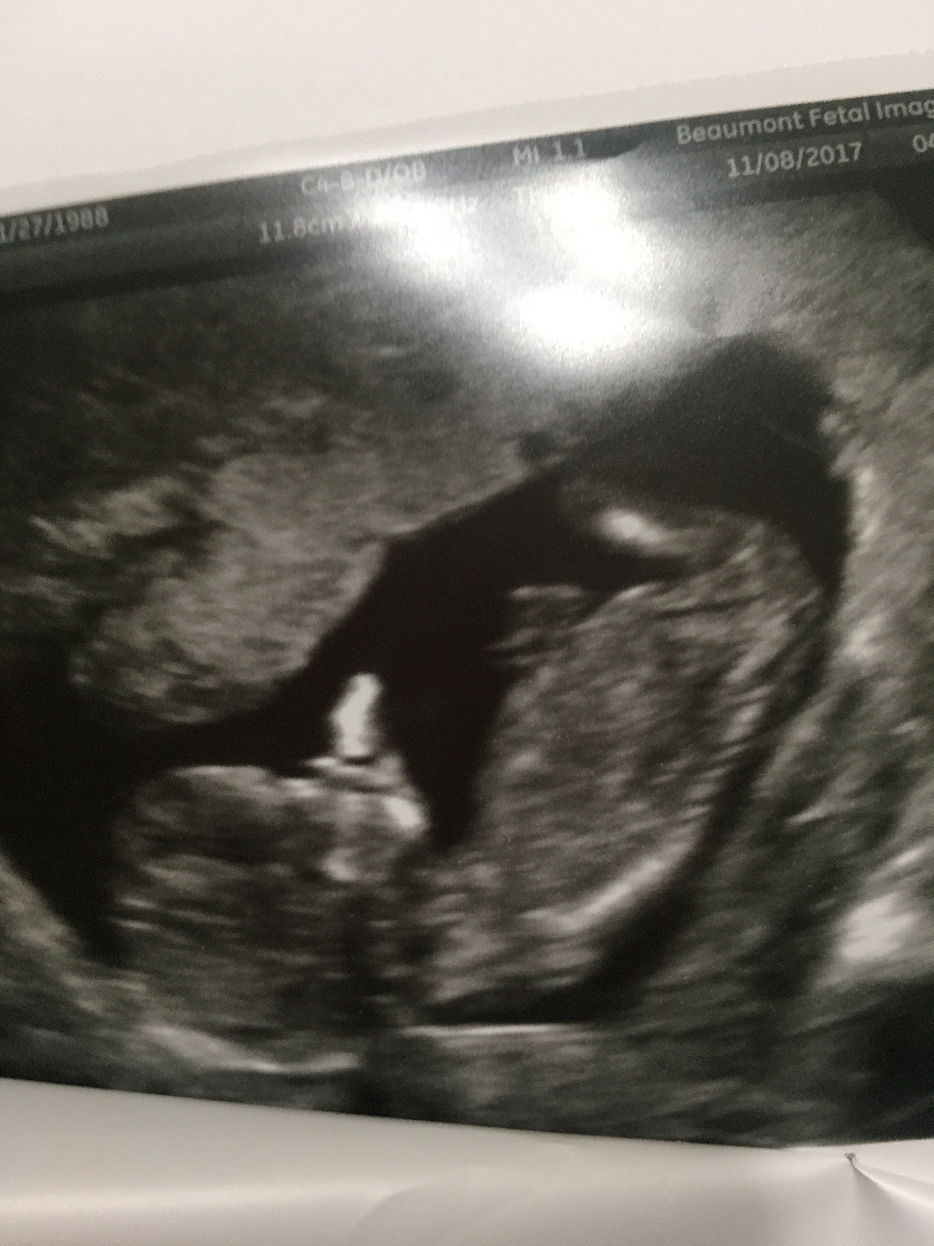 Luxury Down Syndrome 11 Weeks Pregnant Ultrasound hd wallpaper