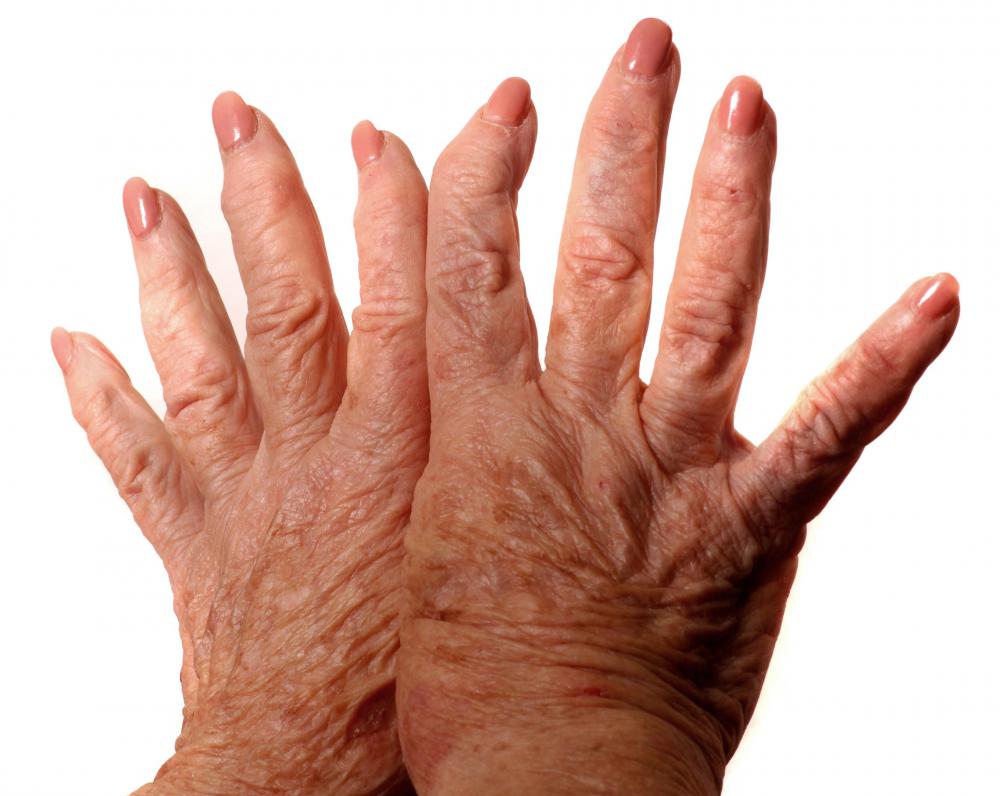 What is Acute Lupus? (with pictures)