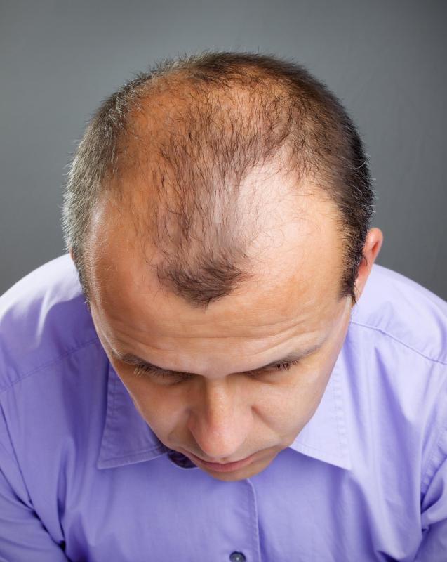 What is Alopecia? (with pictures)