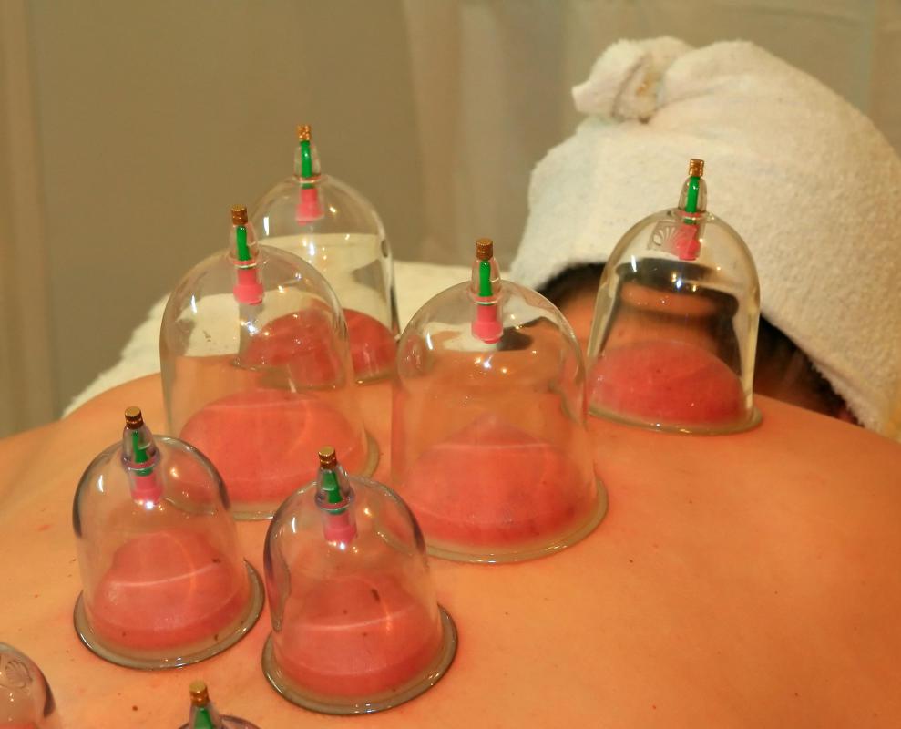 What is Fire Cupping? (with pictures)