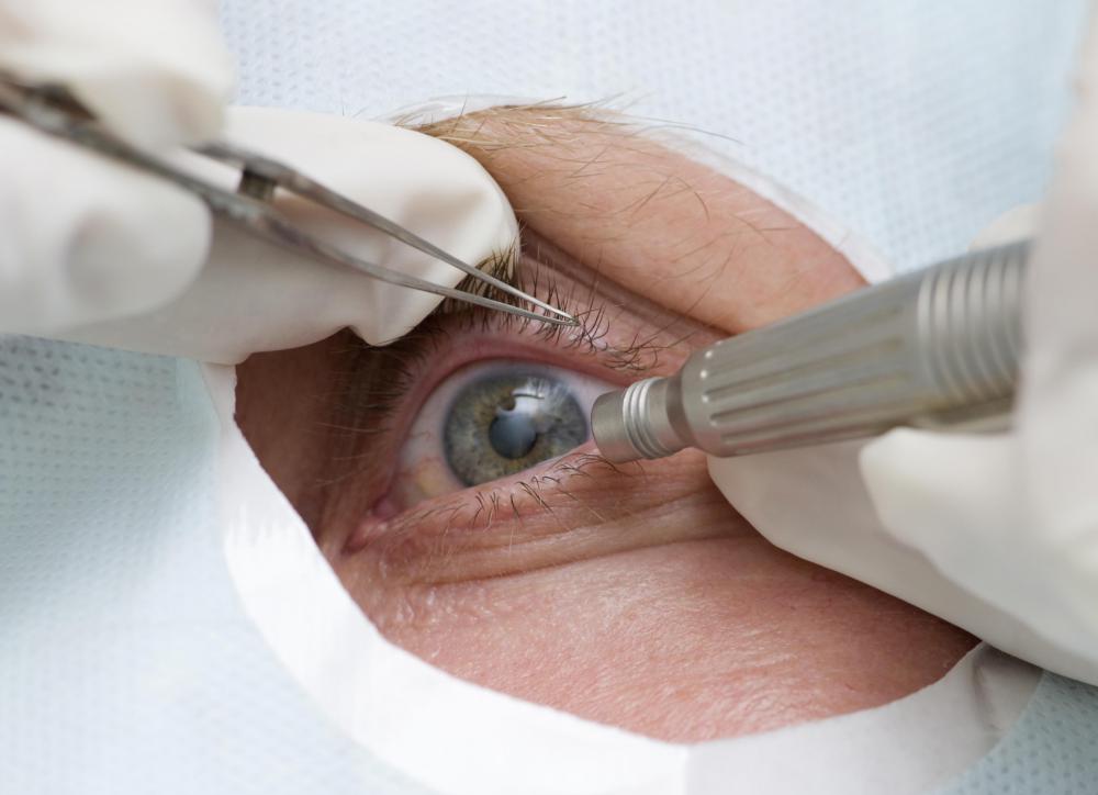 What is Subcapsular Cataract Surgery? (with pictures)
