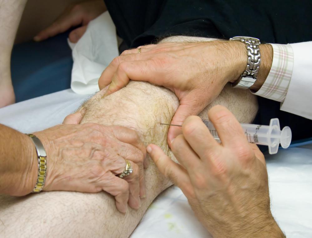 What is Bipartite Patella? (with pictures)