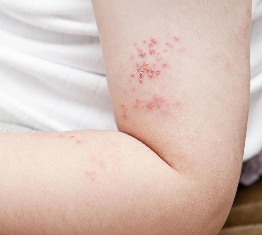 What are the Most Common Causes of Nerve Pain in the Arm?