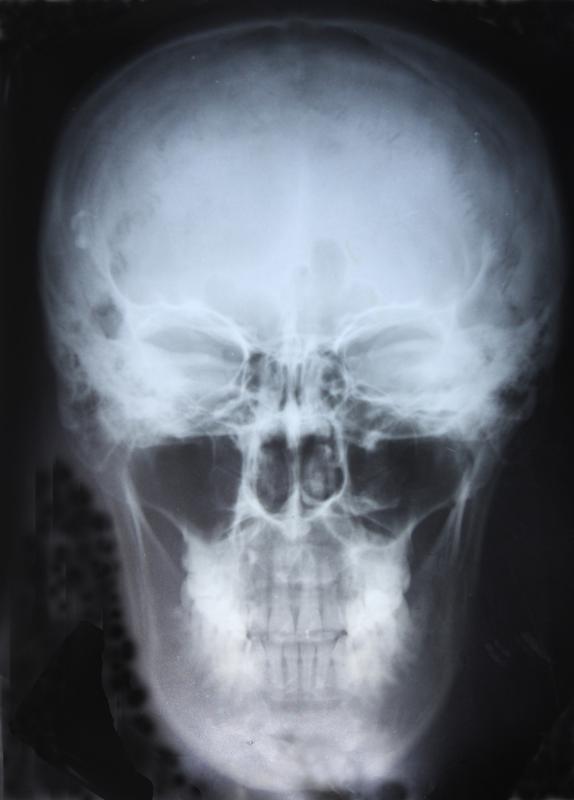 Maxillary Sinus Radiograph
