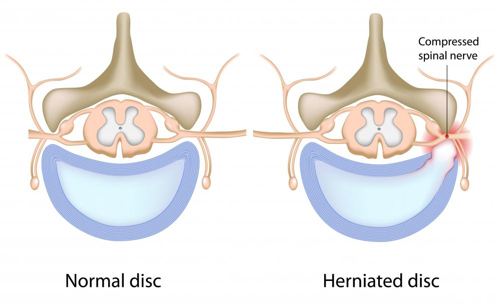 What are the Most Common Causes of Upper Back Pain Between the Shoulder