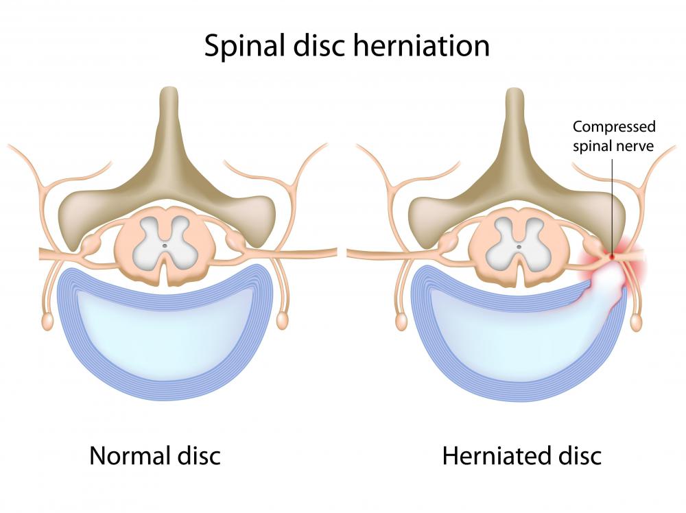 What is Involved in Back Surgery for a Herniated Disc?