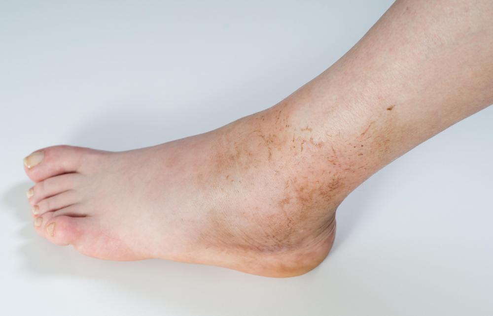 What is Nephrosis? (with pictures)