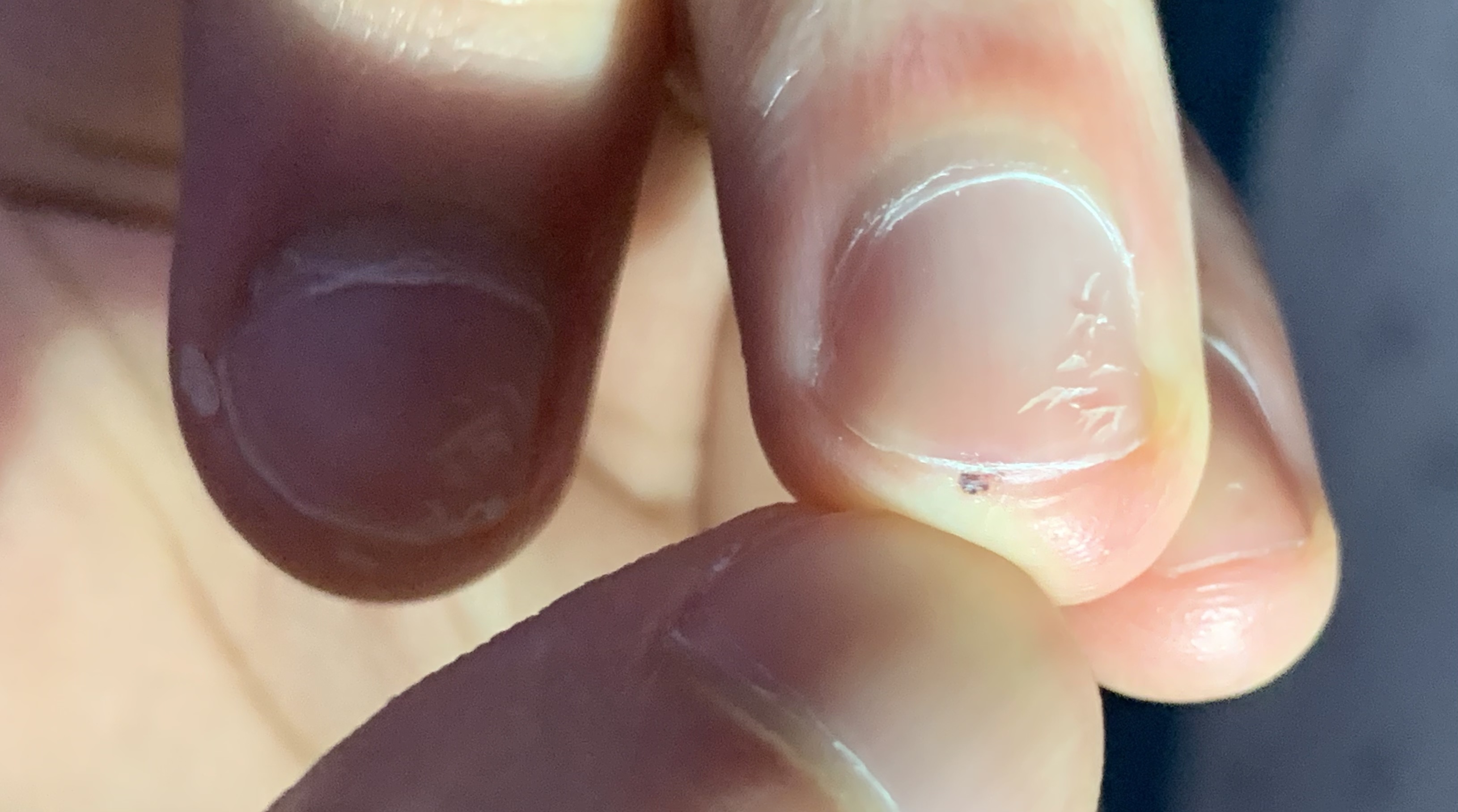 What is this black spot under my nail medical_advice