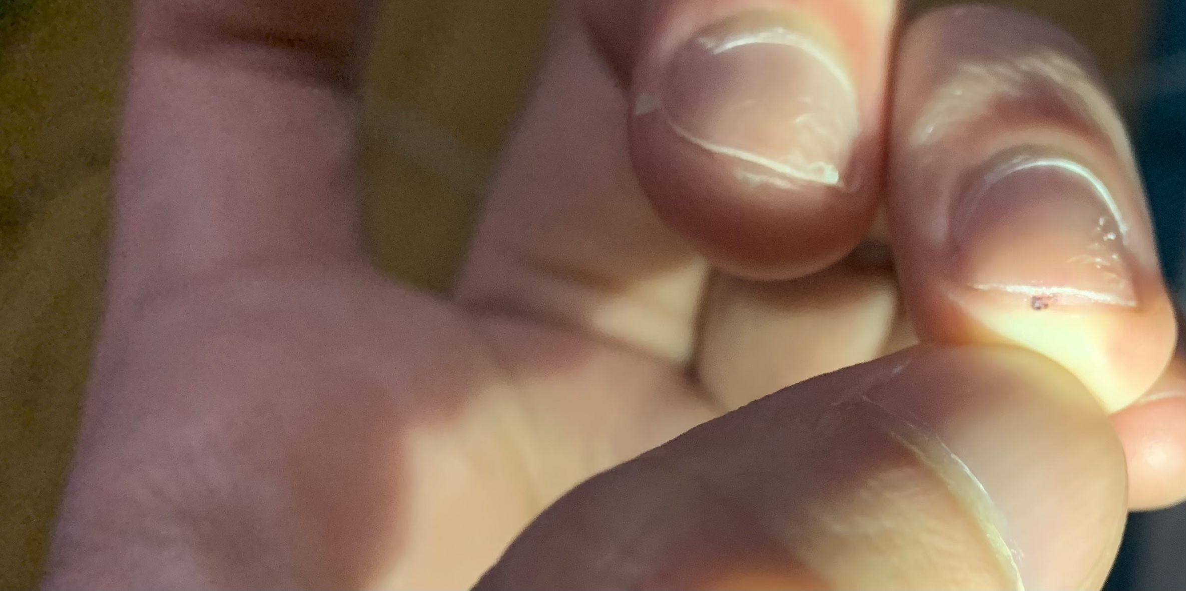 What is this black spot under my nail medical_advice