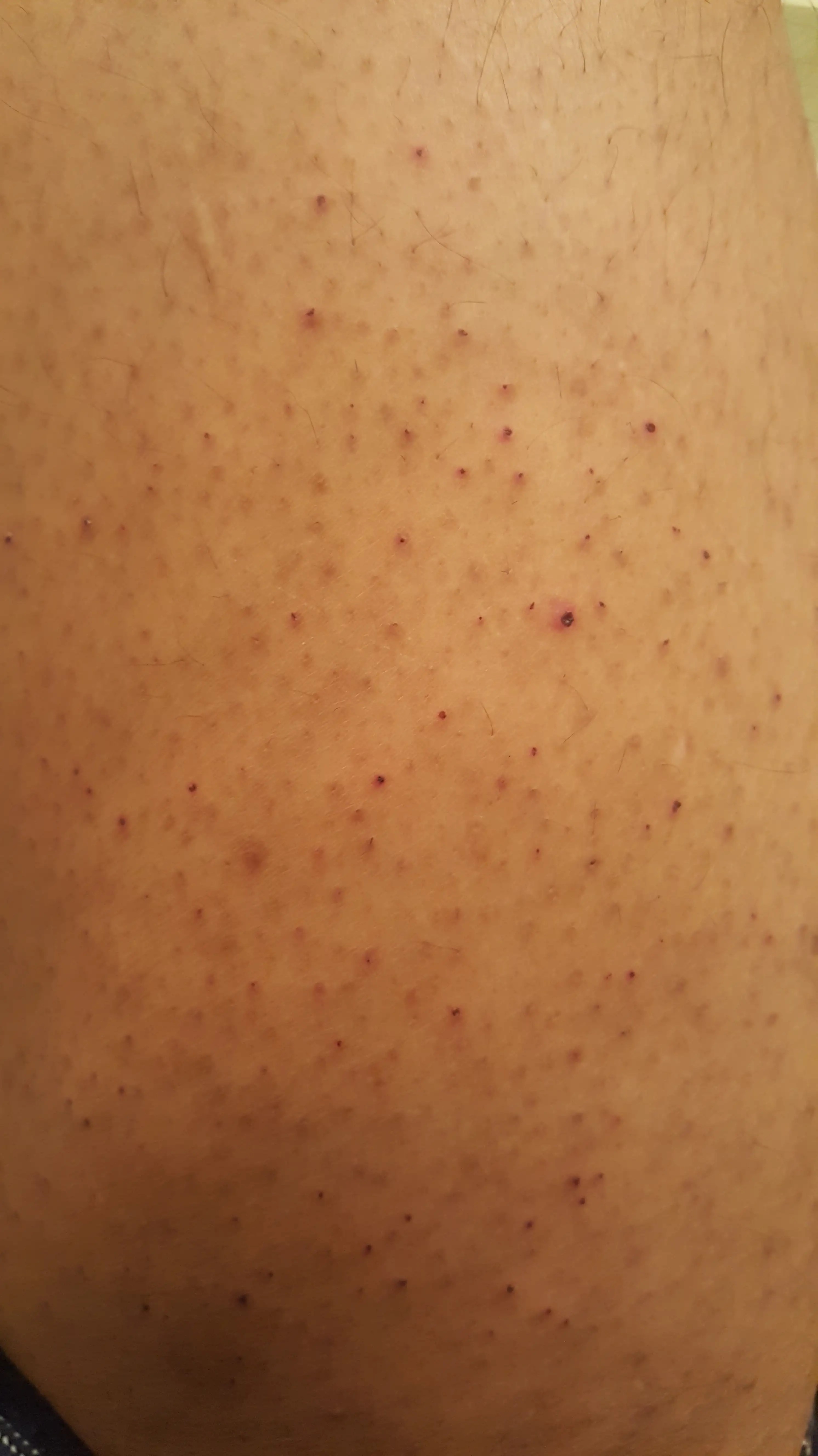 Ingrown Hair Scar Tissue / Ingrown Hair Fade Ingrown Hair Scars