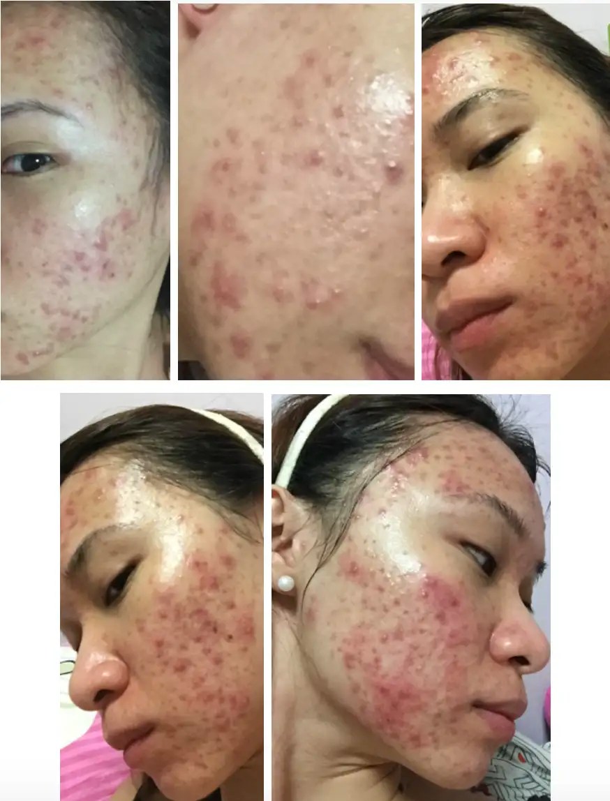 [Review] The LongLasting Cure for Cystic Acne at The Clifford Clinic
