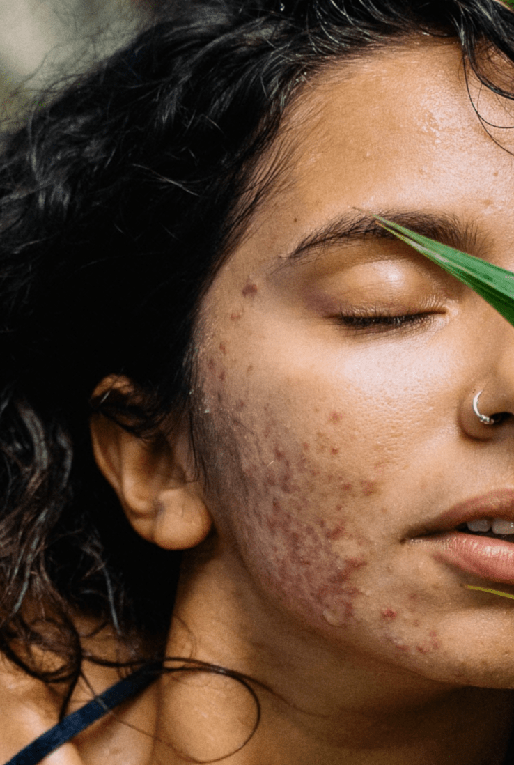 C. acnes Acne Model • Imavita • Preclinical efficacy CRO