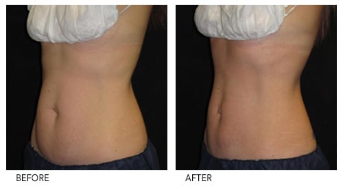 Coolsculpting in Grand Junction at Bellezza Laser Aesthetics