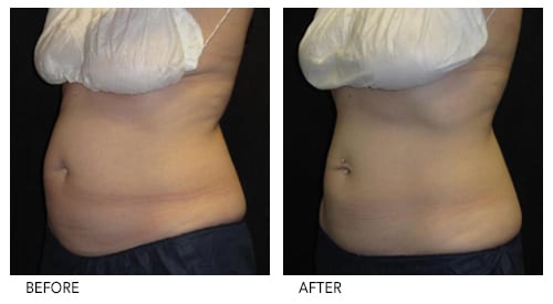Coolsculpting in Grand Junction at Bellezza Laser Aesthetics