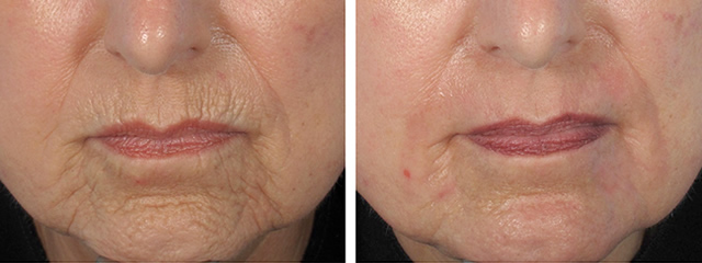 Arrugas del Labio Superior Acupulse Instituto Medico EstetiK