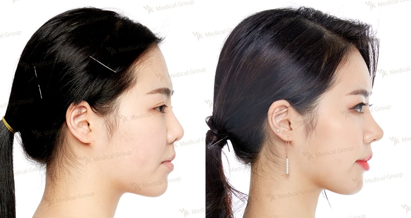 ≡ Top 5 cheapest countries for rhinoplasty (nose job) in