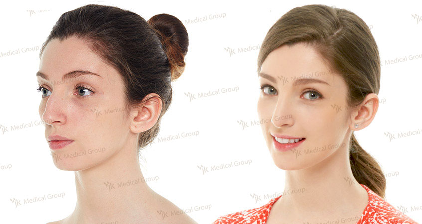 ≡ Top 5 cheapest countries for rhinoplasty (nose job) in