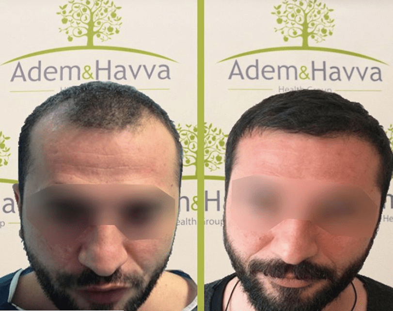 ᐈ 5 best countries for hair transplant overseas