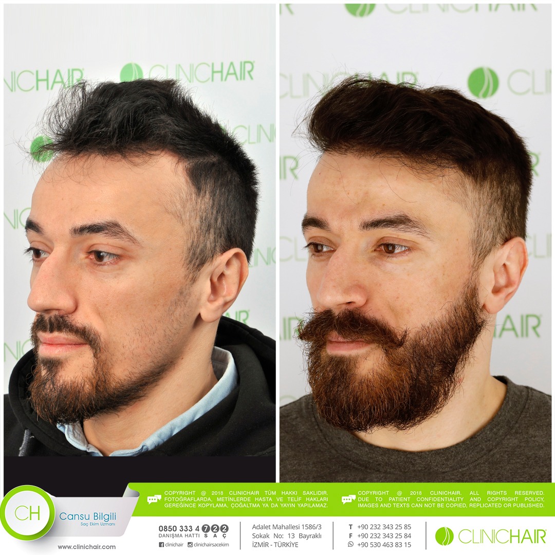 Facial Hair Transplant Price / Beard Transplant Price 2021 Zty Hair