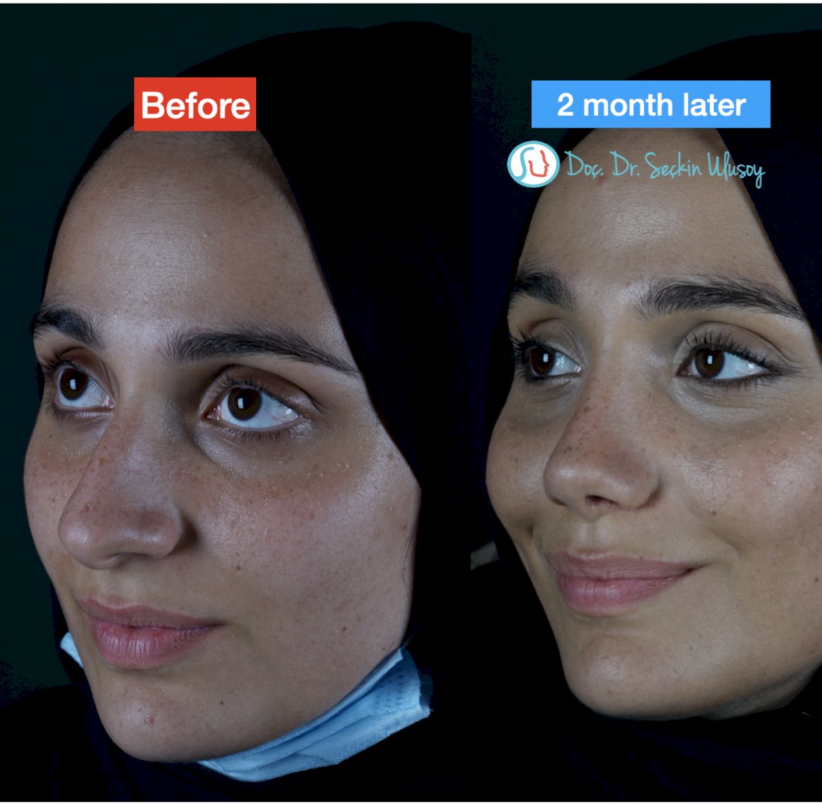 Rhinoplasty (nose job) in Turkey The BEST 45 clinics ‎ Prices 2021