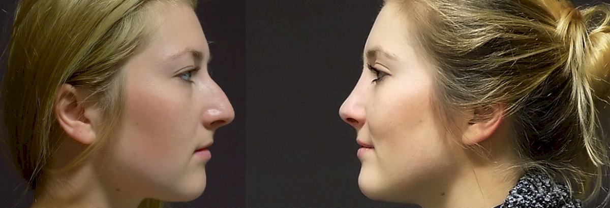 ≡ Top 5 cheapest countries for rhinoplasty (nose job) in