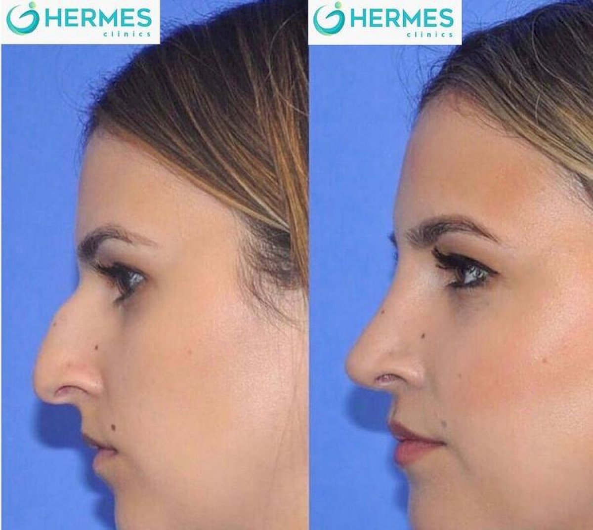 Cost of Rhinoplasty (nose job) in İzmir (Turkey) 2 clinics, reviews