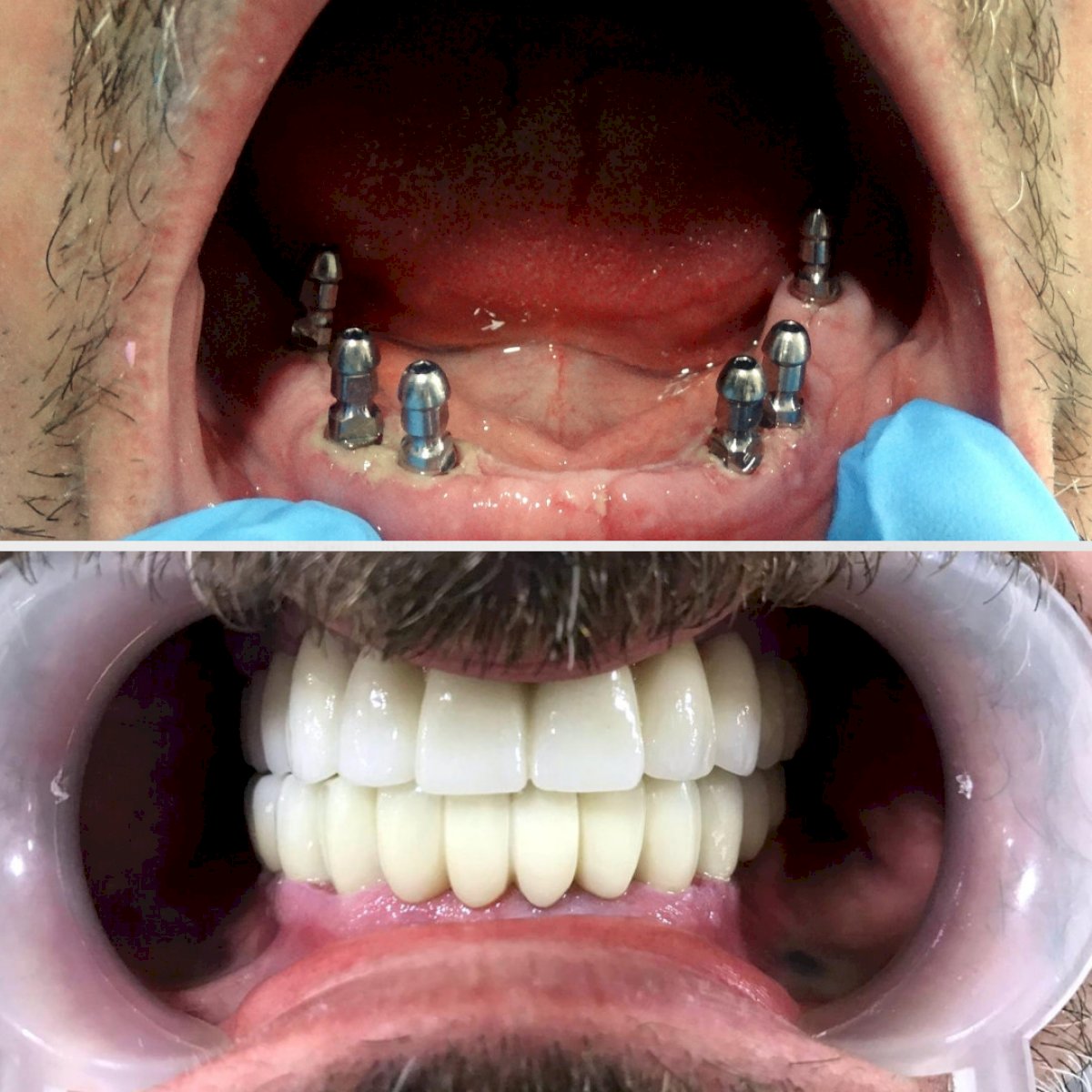 Allon6 Dental Implants in Turkey The BEST 22 clinics ‎ Prices 2021