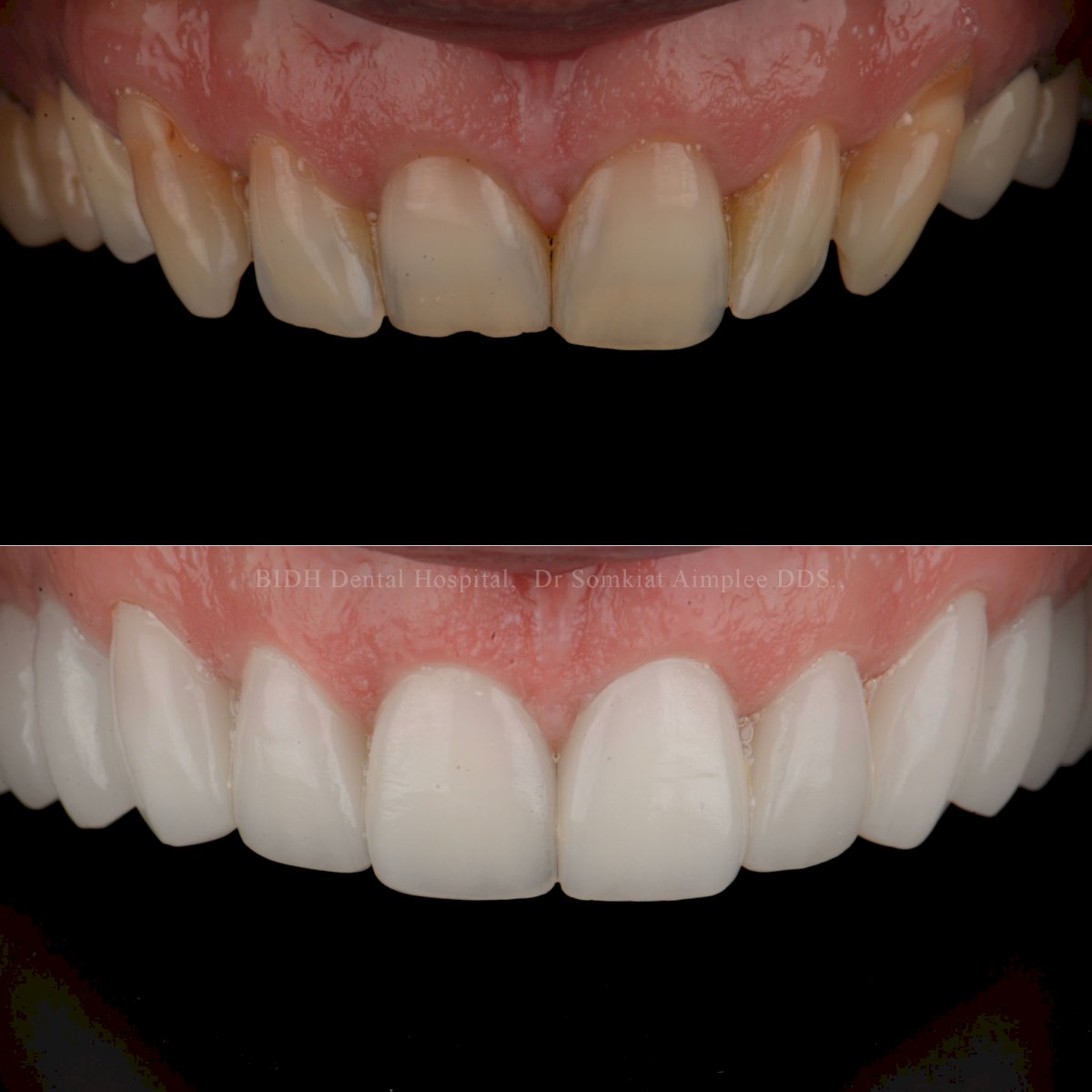 Porcelain Veneer in Thailand The BEST 9 clinics ‎ Prices 2021