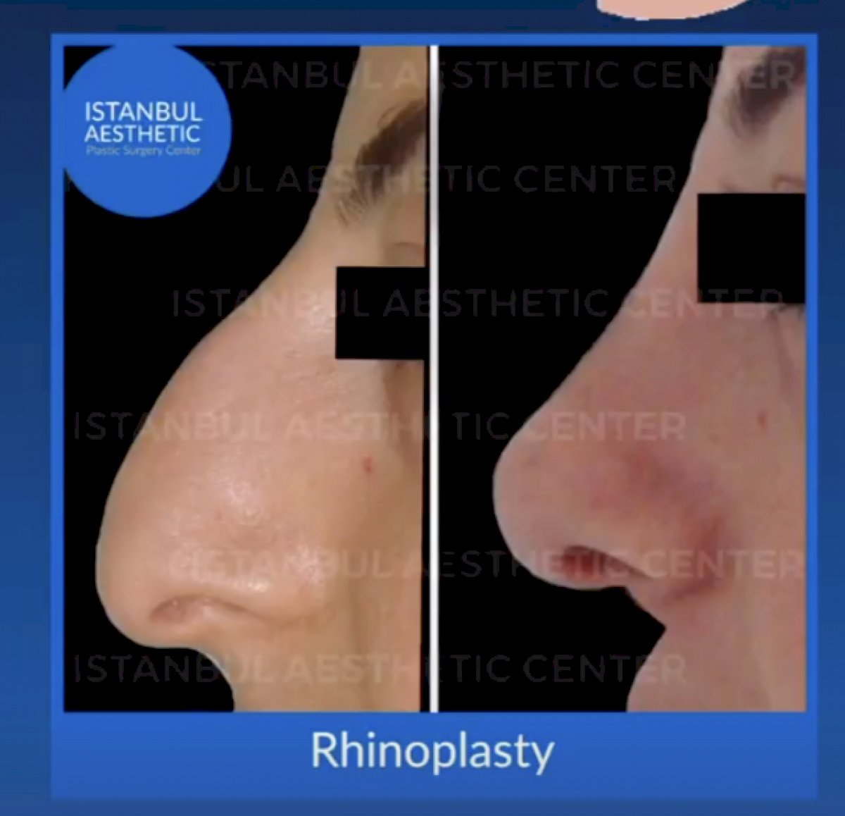 Istanbul Aesthetic Plastic Surgery Center in Turkey 152 reviews