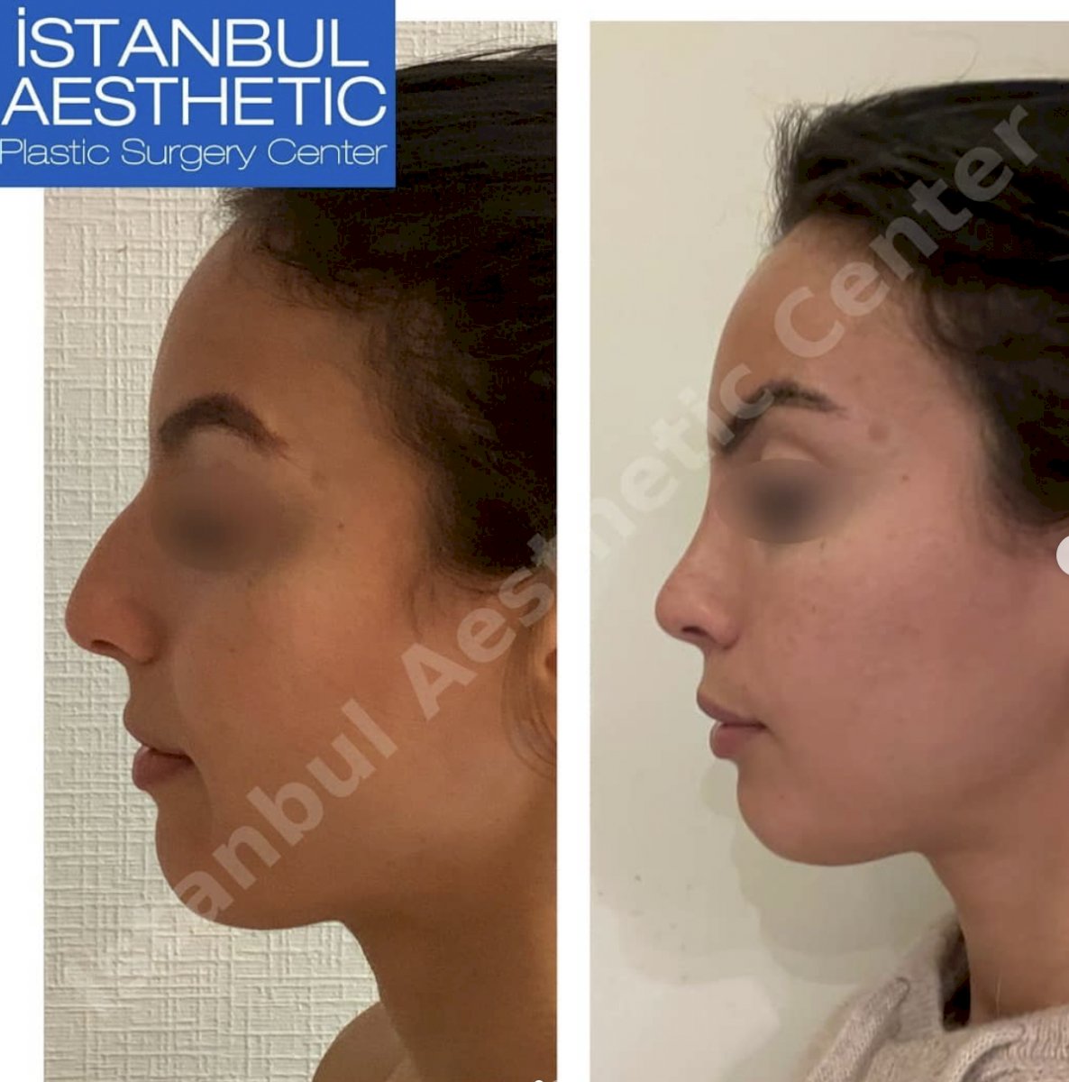 Istanbul Aesthetic Plastic Surgery Center in Turkey 154 reviews